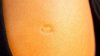 01-Smallpox-vaccine-scar-1296x728-slide1.jpg